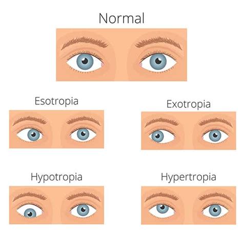 esotropia medical term